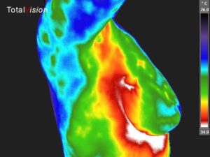 thermografie borstonderzoek happy healthcare
